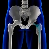 healthy aging hip replacement